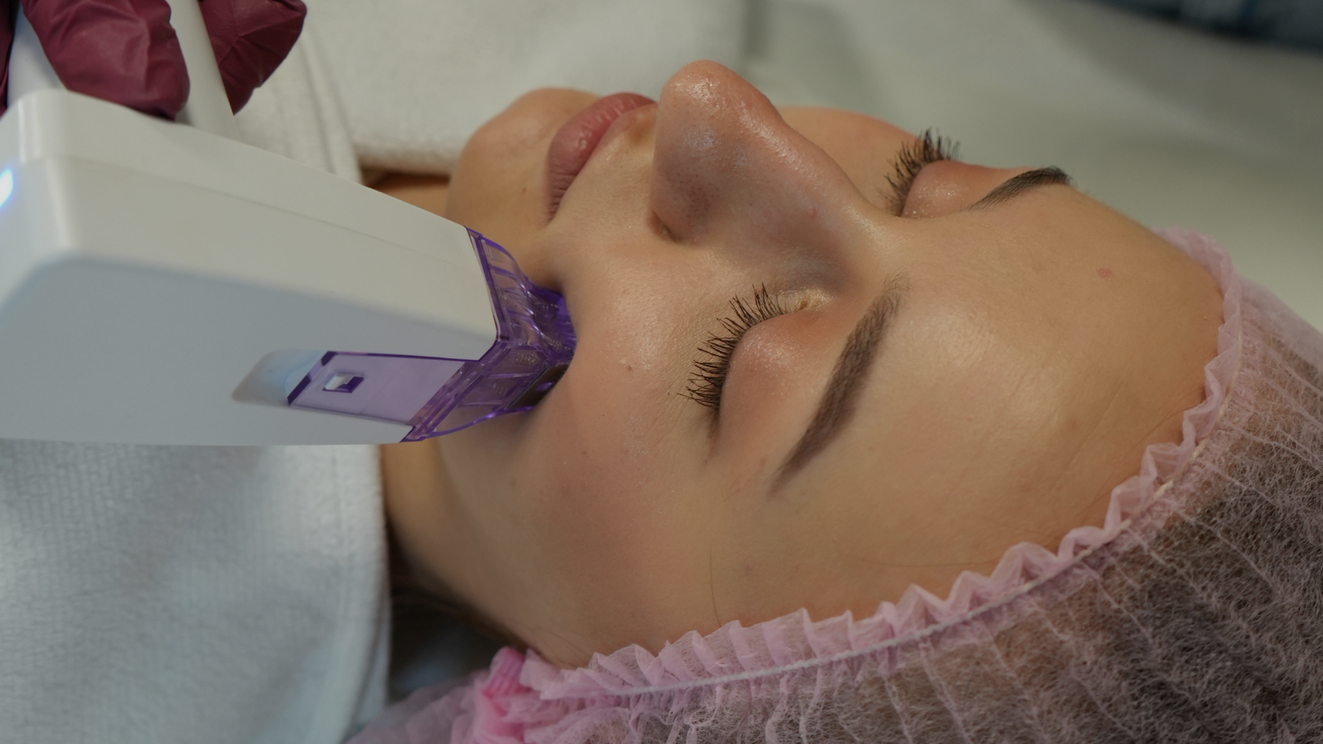 RF-Microneedling Behandlung im Gesicht bei SkinPerfect Bayreuth zur Hautstraffung und Faltenreduktion.